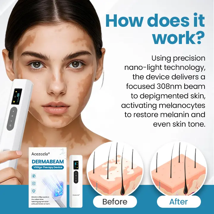 Zariadenie na terapiu Vitiligo Acezozla® DermaBeam - Image 3