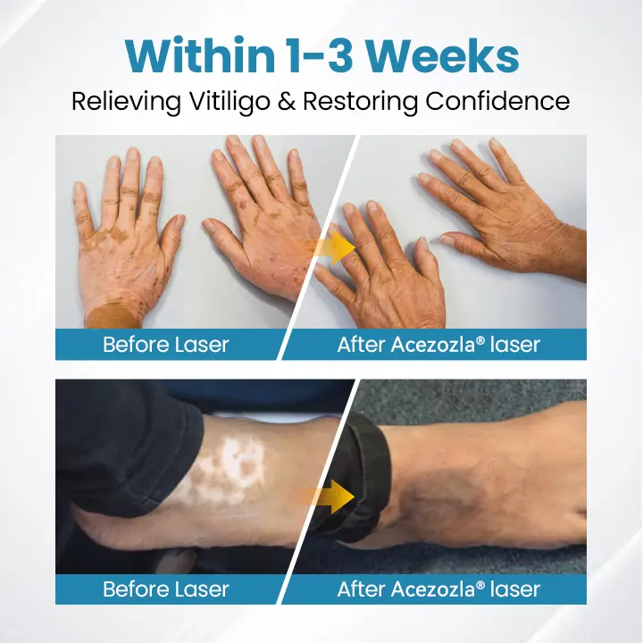 Zariadenie na terapiu Vitiligo Acezozla® DermaBeam - Image 4