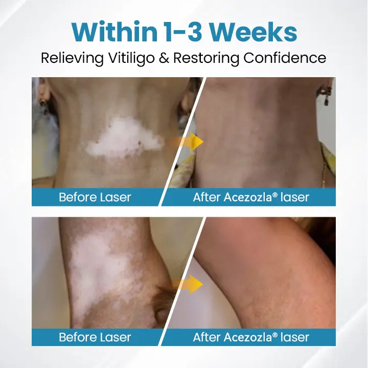 Zariadenie na terapiu Vitiligo Acezozla® DermaBeam - Image 5