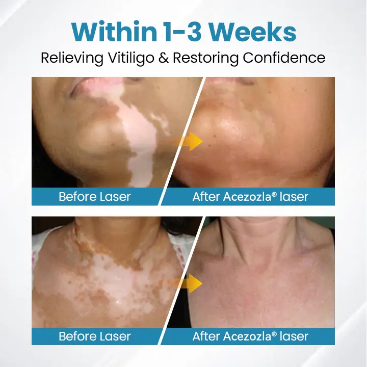 Zariadenie na terapiu Vitiligo Acezozla® DermaBeam - Image 7