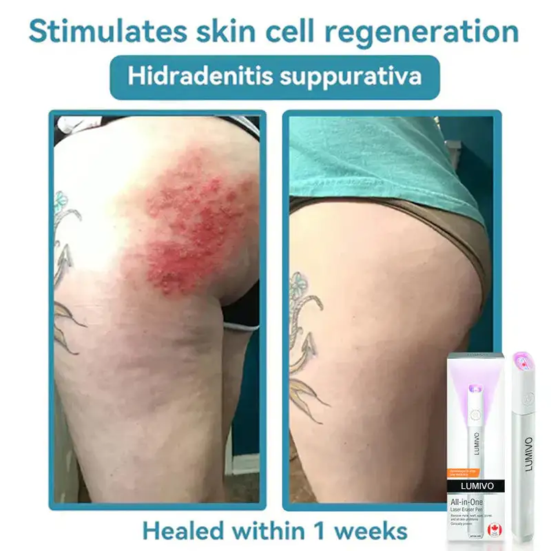 LUMIVO™ All-in-One CO₂ laserové gumové pero - Image 12